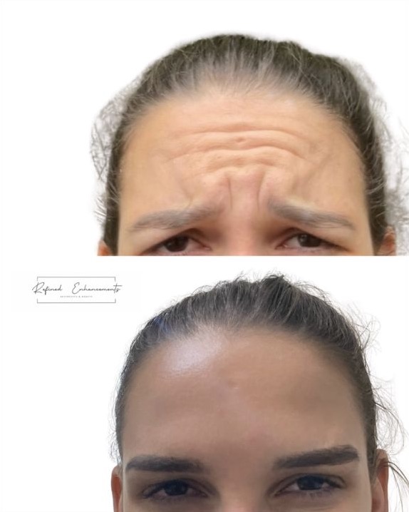 Full before-and-after anti-wrinkle comparison published by Refined Enhancements