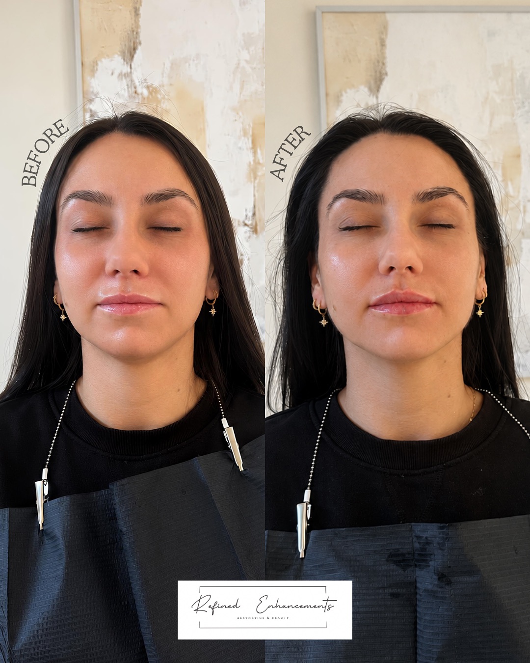 Full before-and-after facial balancing comparison published by Refined Enhancements