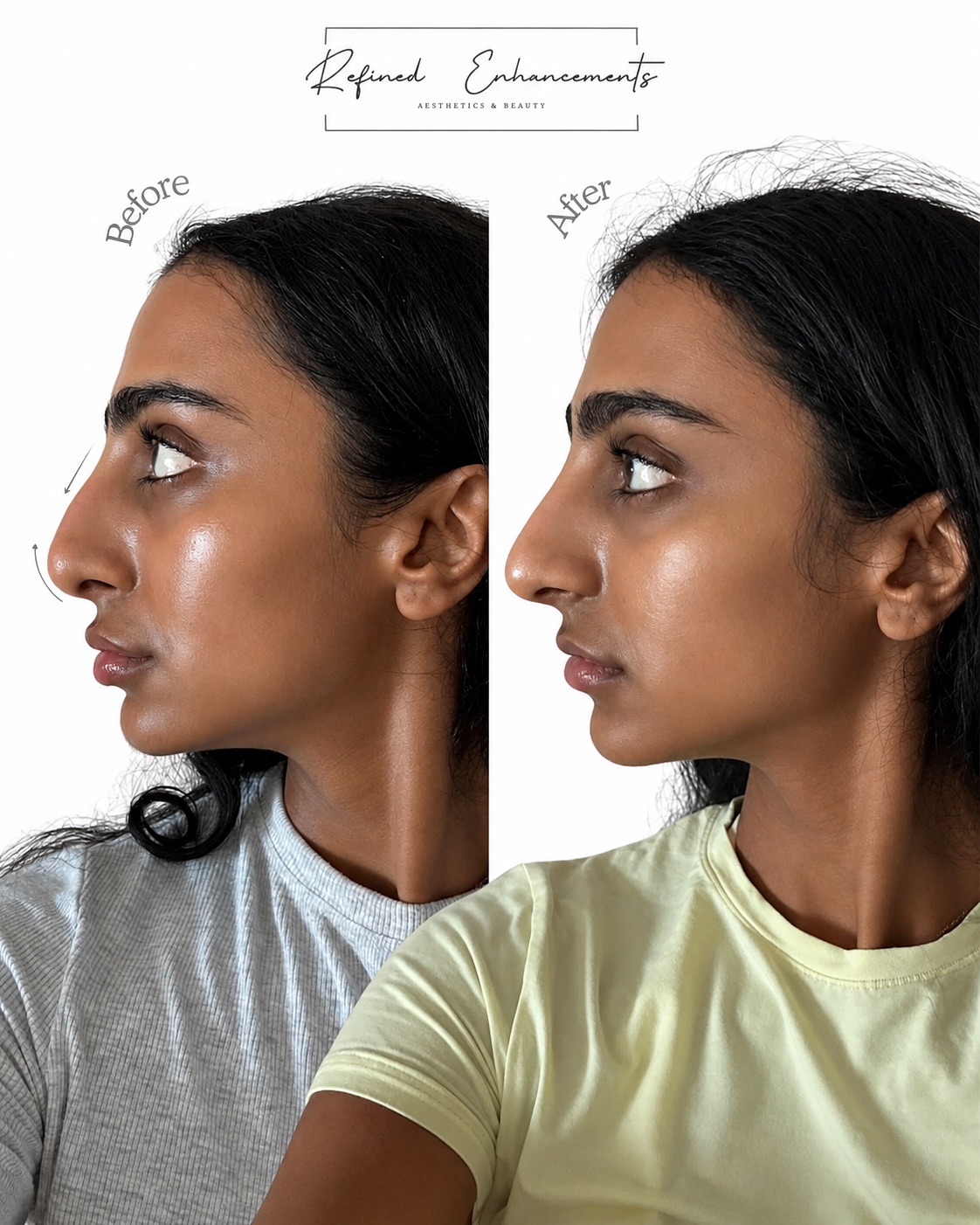 Full before-and-after non-surgical rhinoplasty comparison published by Refined Enhancements