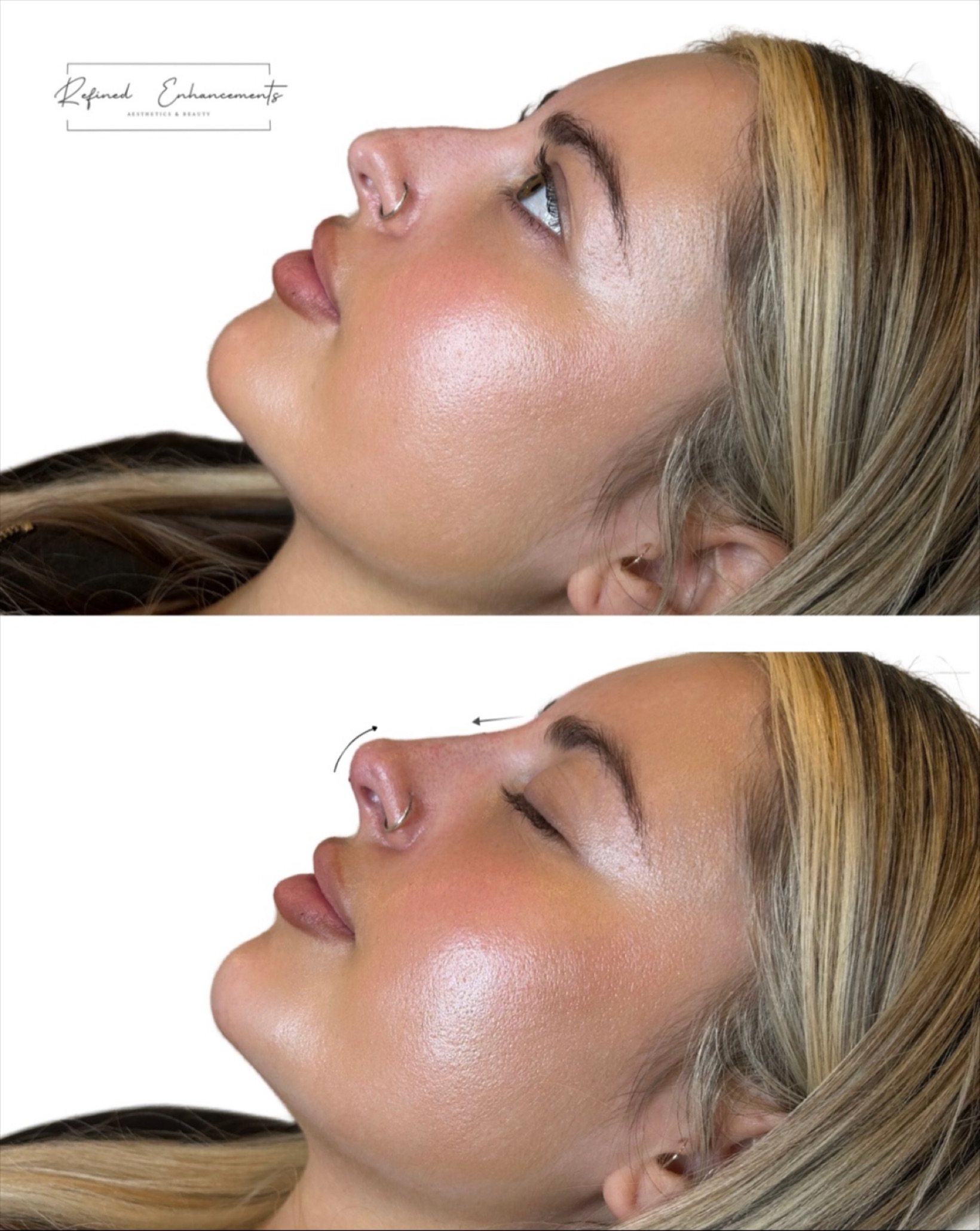 Published non-surgical rhinoplasty comparison by Refined Enhancements